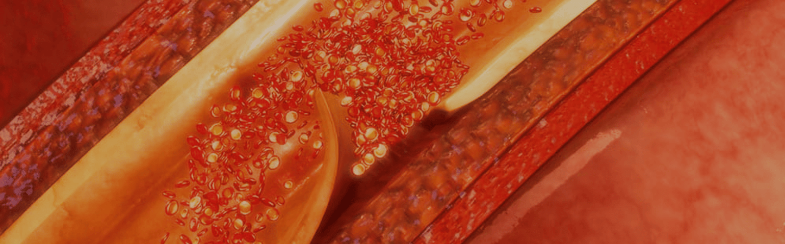 Implantes de Marcapasso