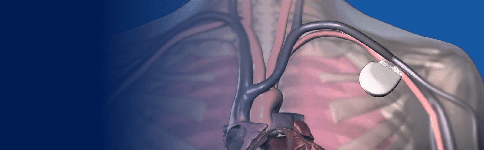 Transplante Cardíaco